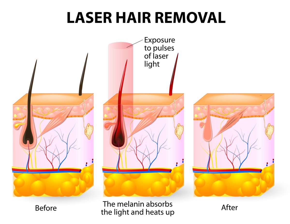 Hair Removal - Zeiva Professional Center