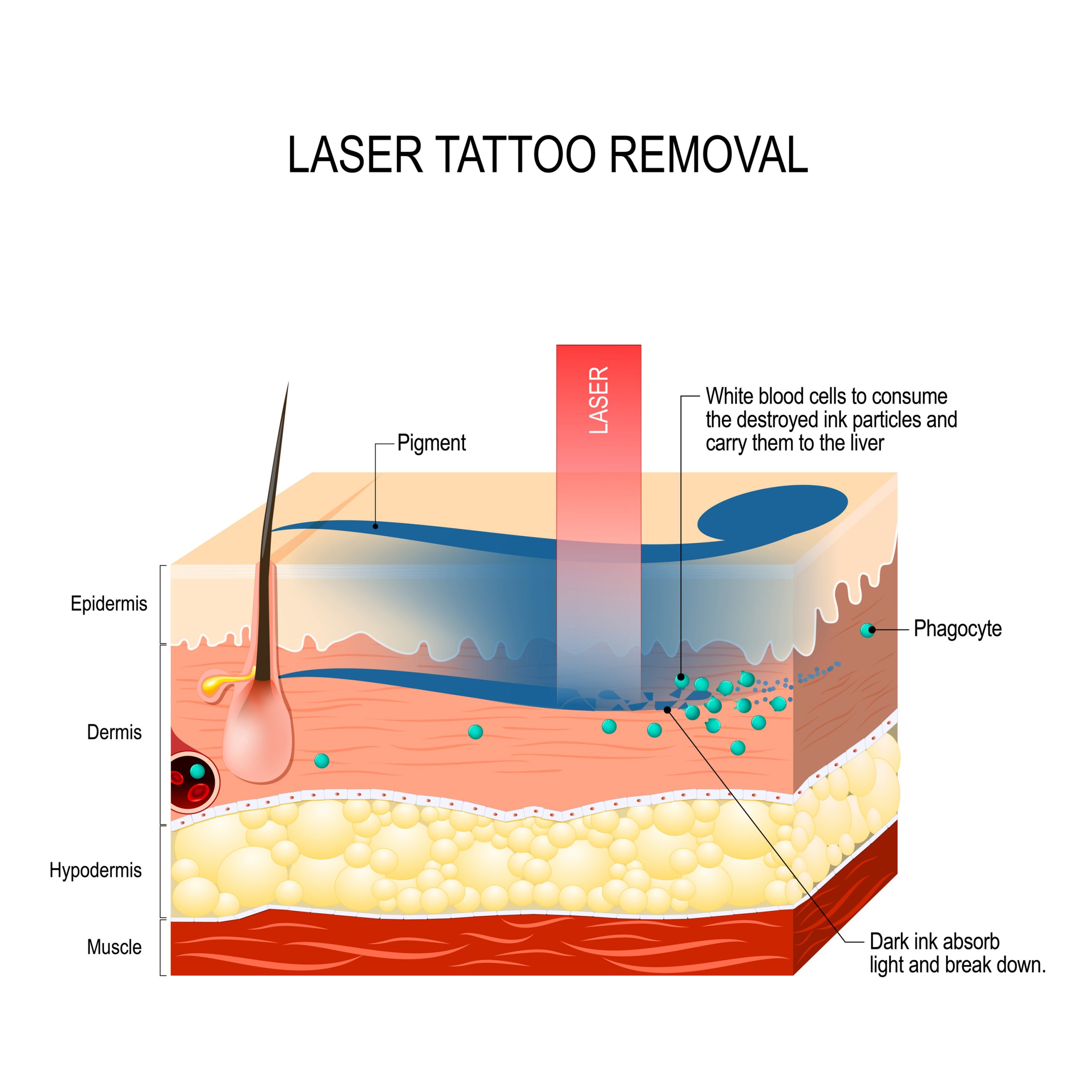 Health Implications Of Tattoo Removal: Is It Safe? | Credihealth